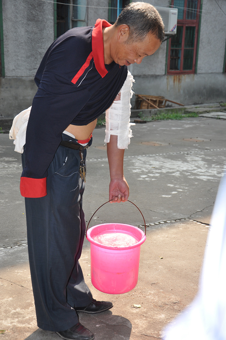 梅山水师卿同喜为医院手术接骨失误患者断臂接骨3.jpg